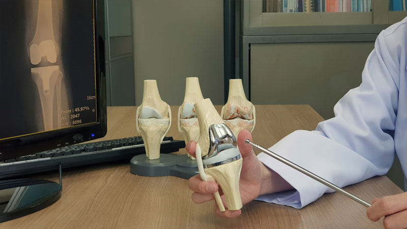 Everything You Need to Know About Total Knee Replacement