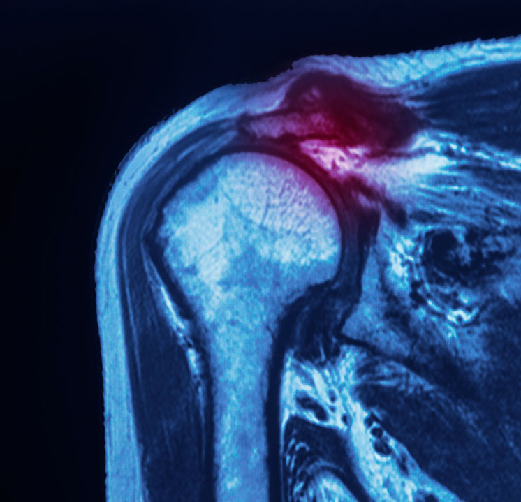 An MRI scan of a shoulder joint, with a red highlight indicating the location of a SLAP tear in the labrum cartilage.